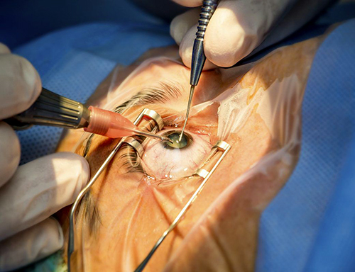 Cirurgia de Catarata