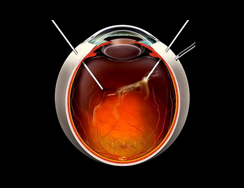 Cirurgia de Retina