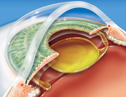 Implantes de Lentes Intraoculares: precisão e conforto visual