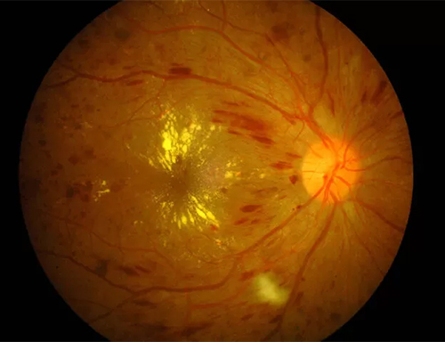 Retinopatia Diabética